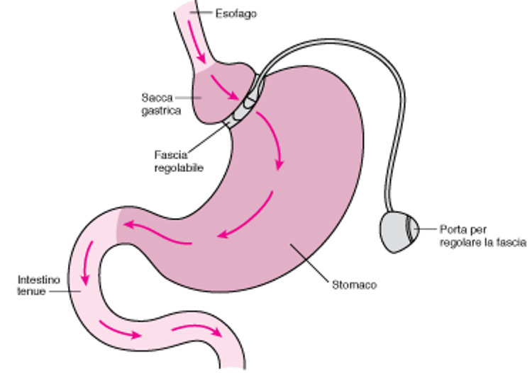 Bendaggio gastrico