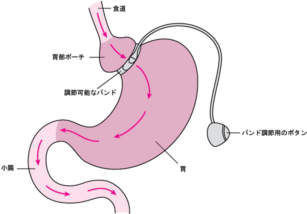 胃いにバンドを巻まく