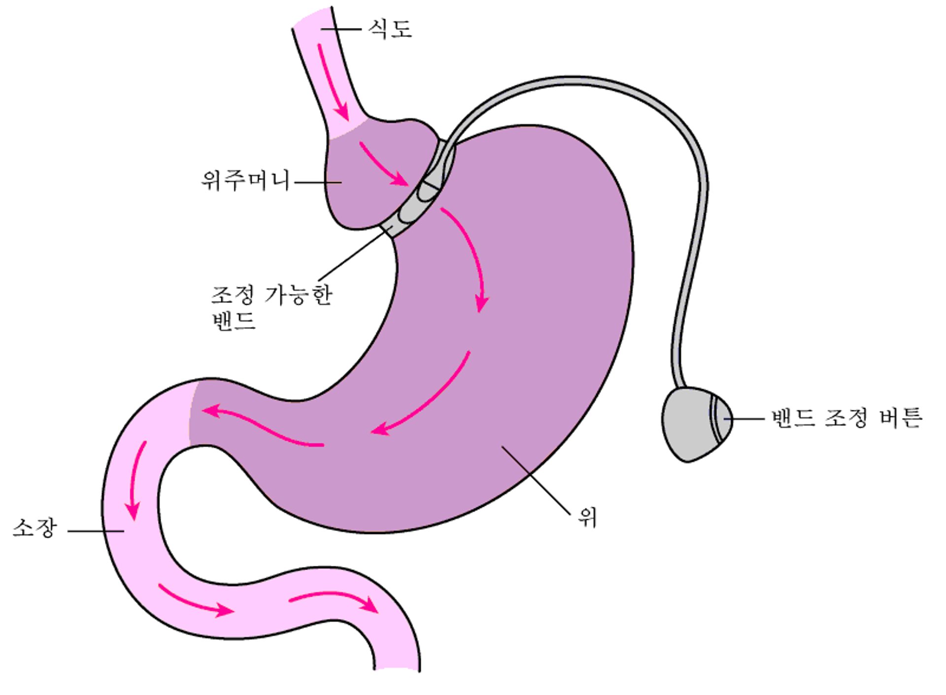 위 밴드술