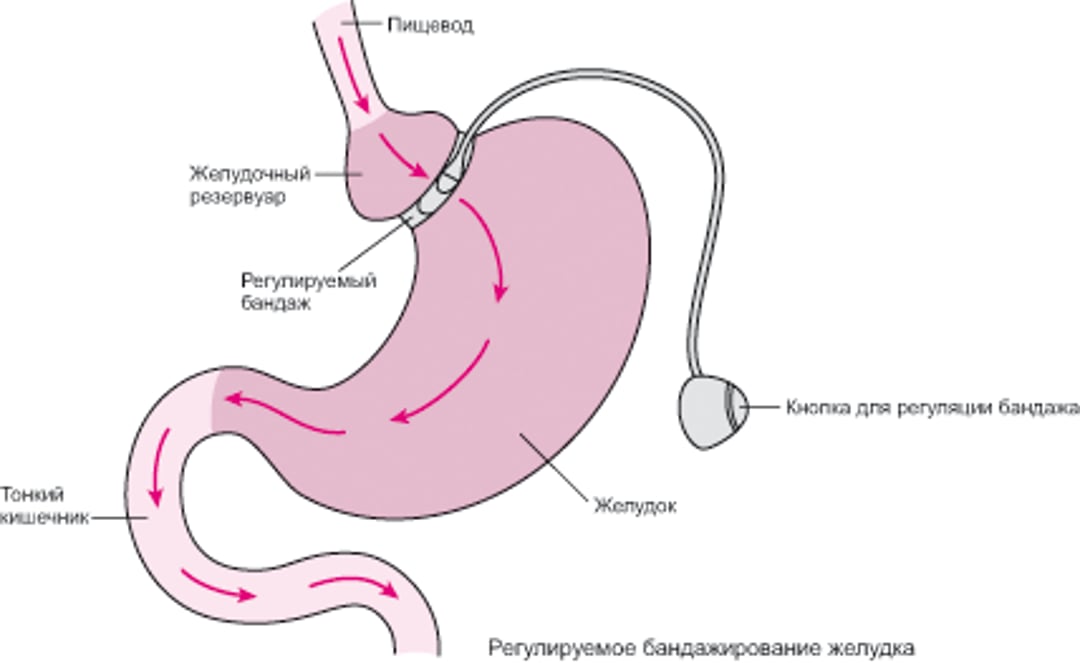 Бандажирование желудка