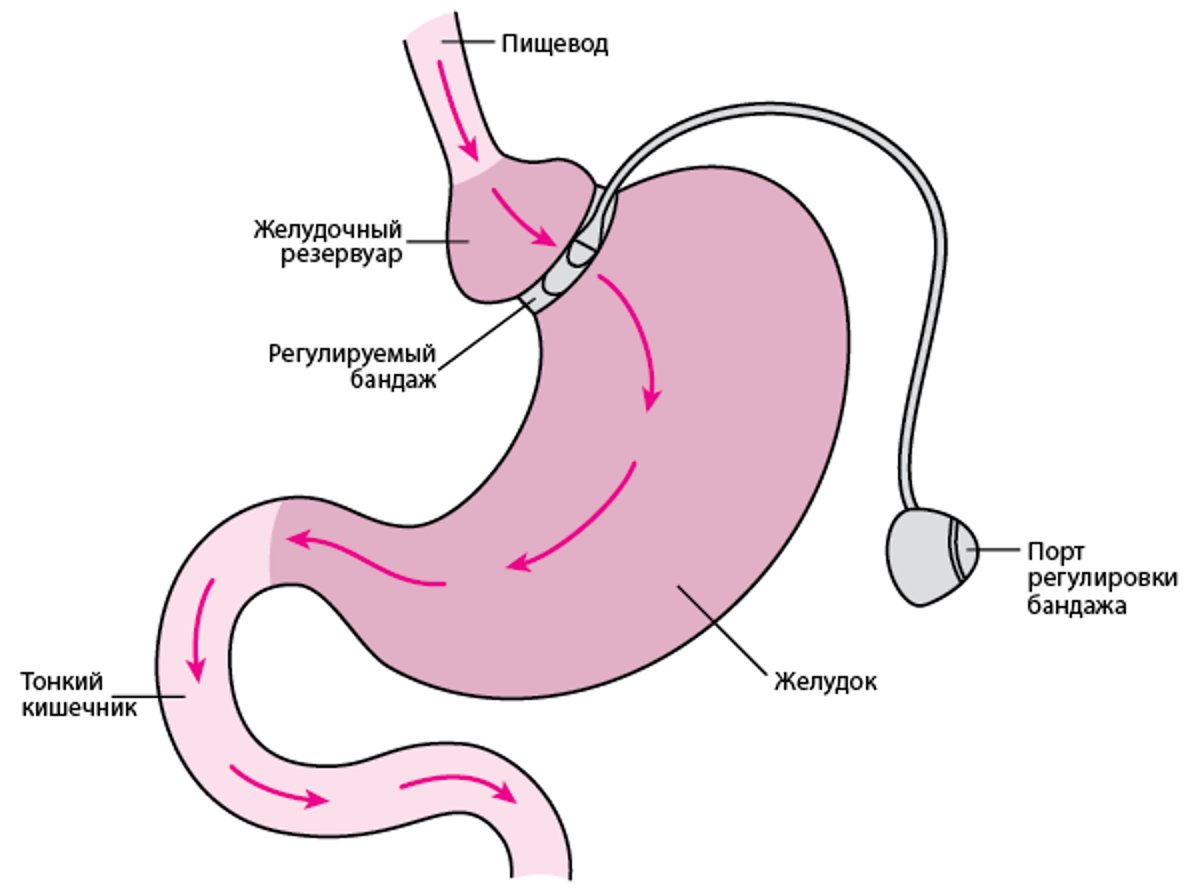 Бандажирование желудка