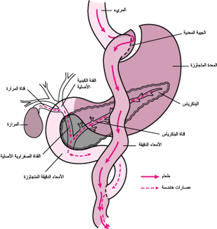 تجاوز جزء من السبيل الهضمي