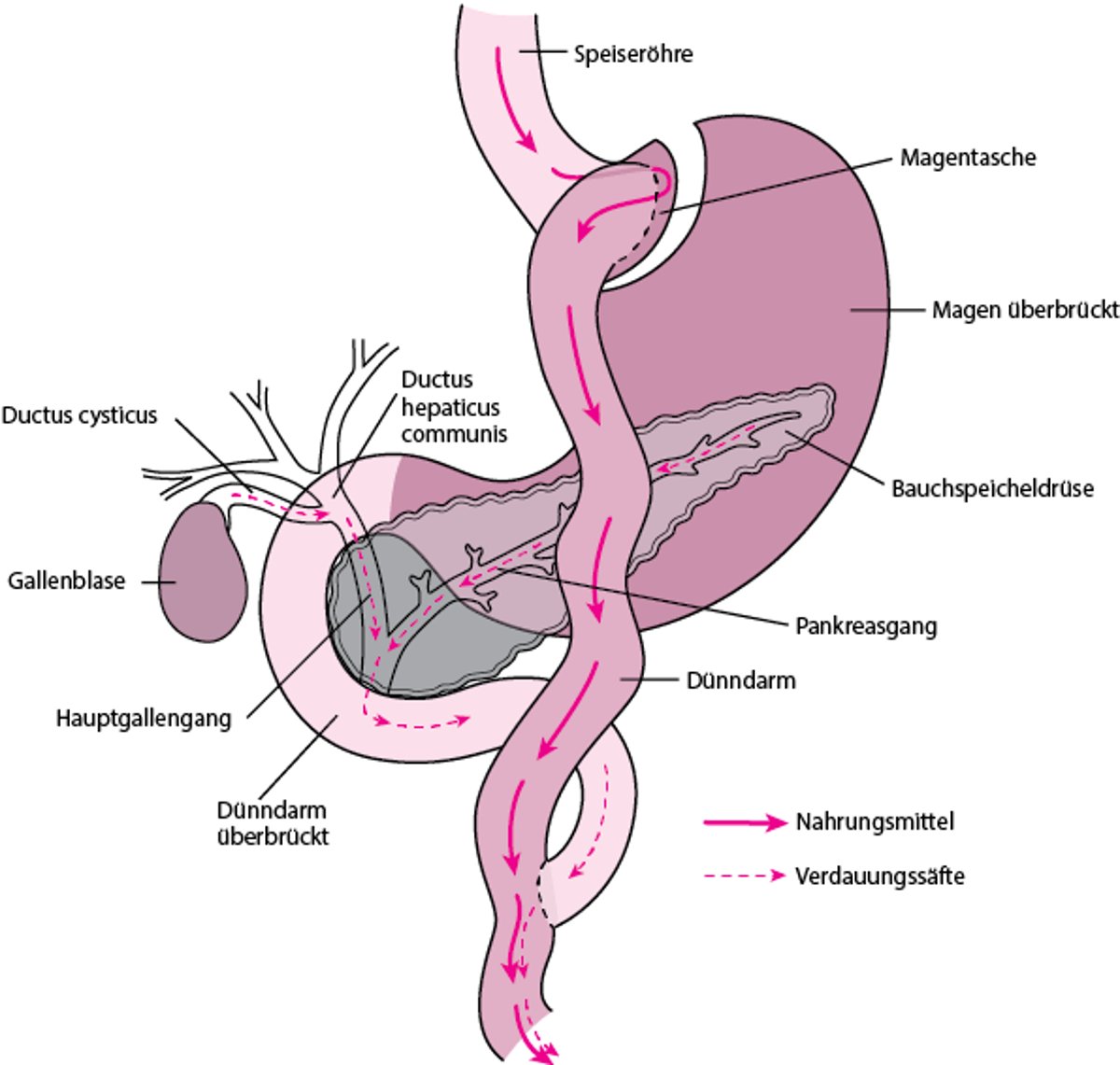 Umgehen eines Teils des Verdauungstrakts