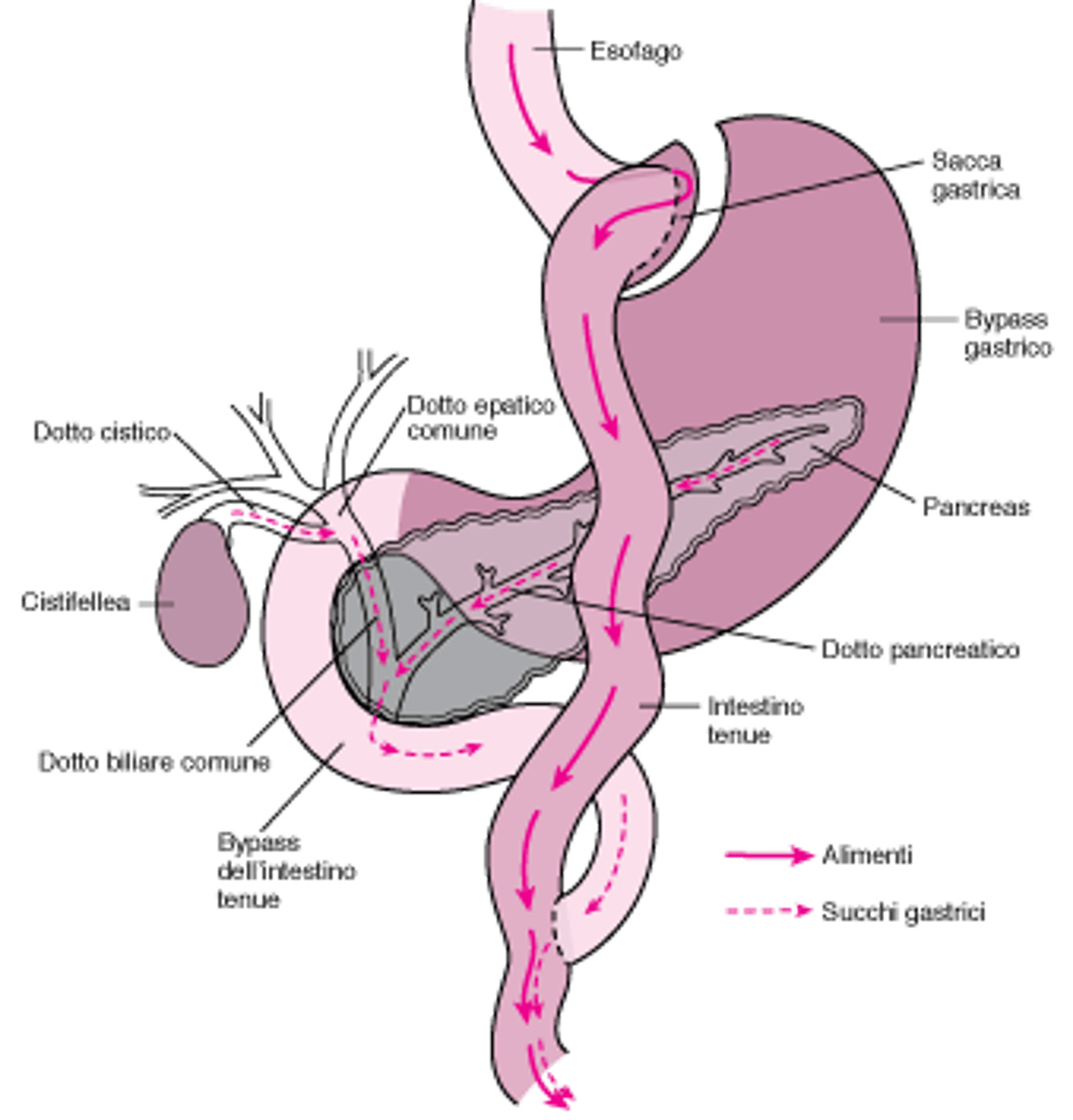 Bypass di una parte dell’apparato digerente