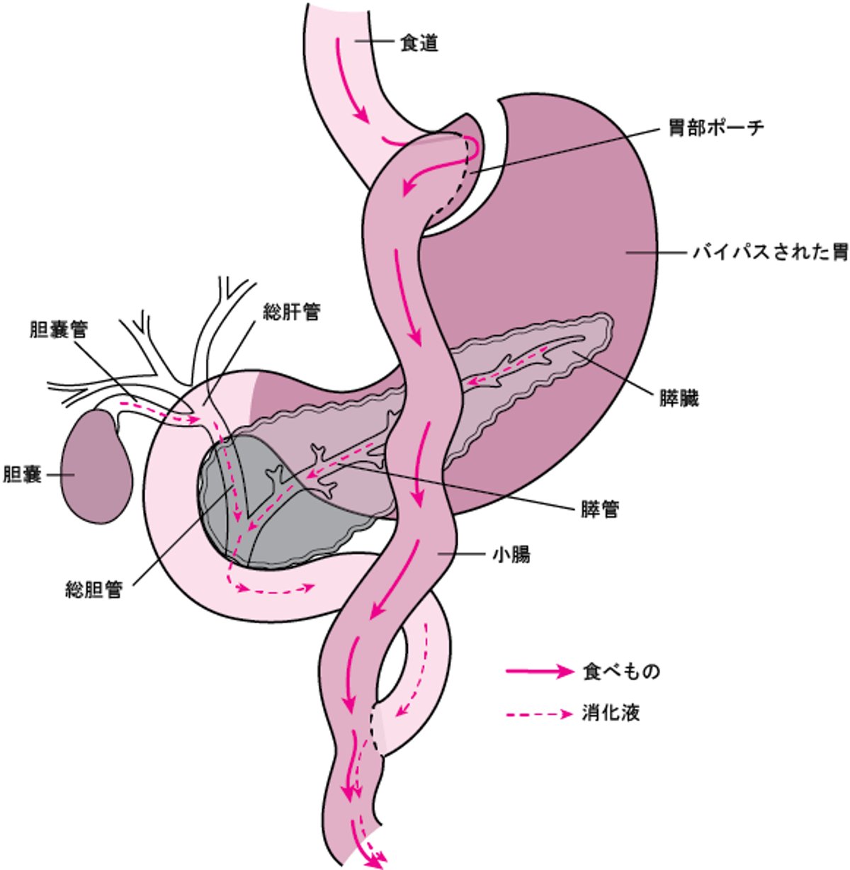 消化管しょうかかんの一部いちぶをバイパスする