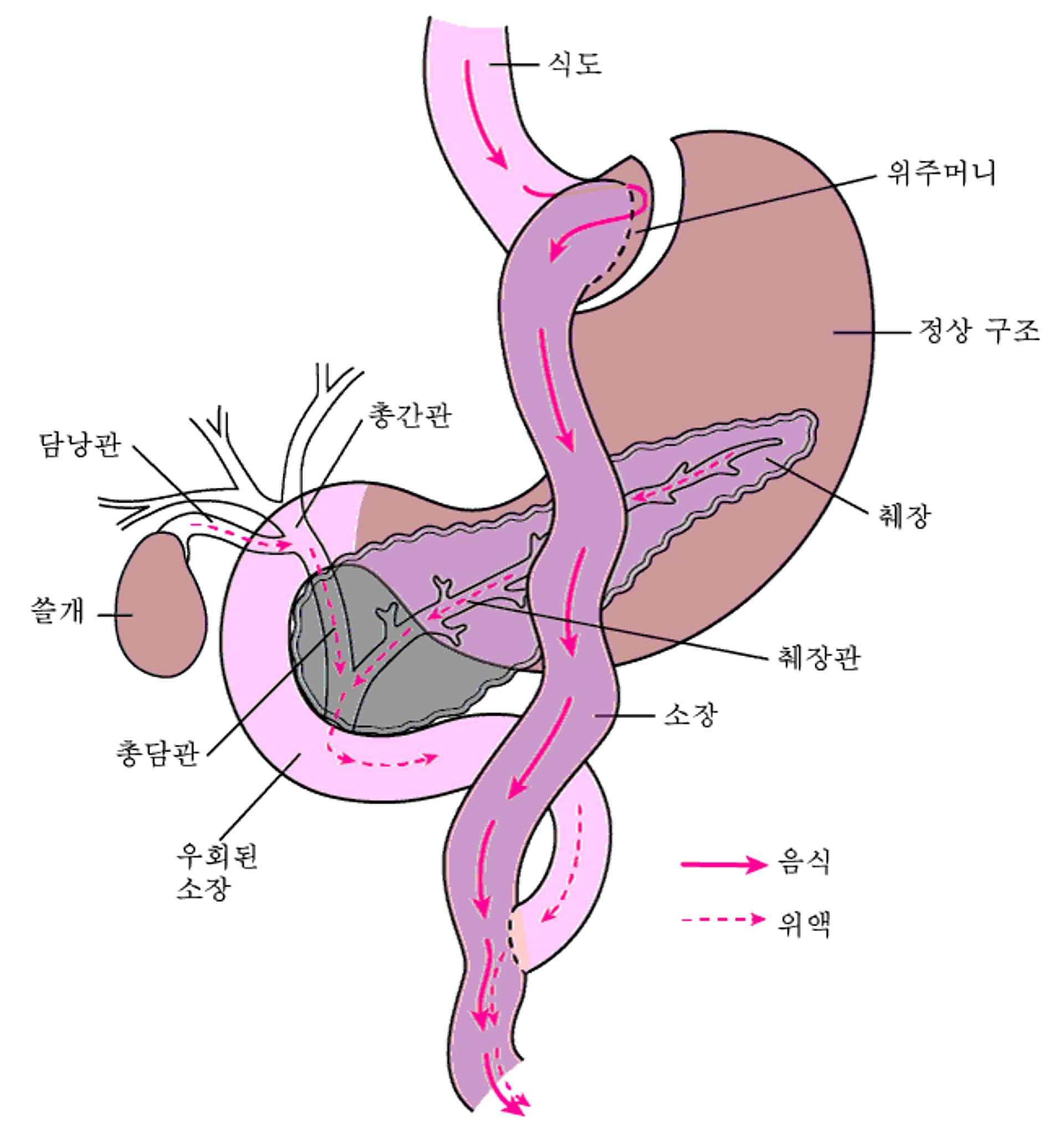 소화관 일부 우회