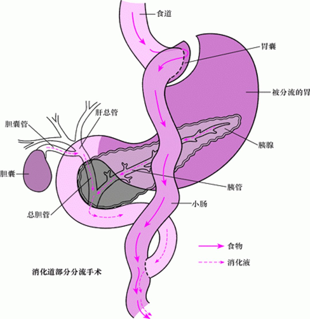 消化道部分分流术