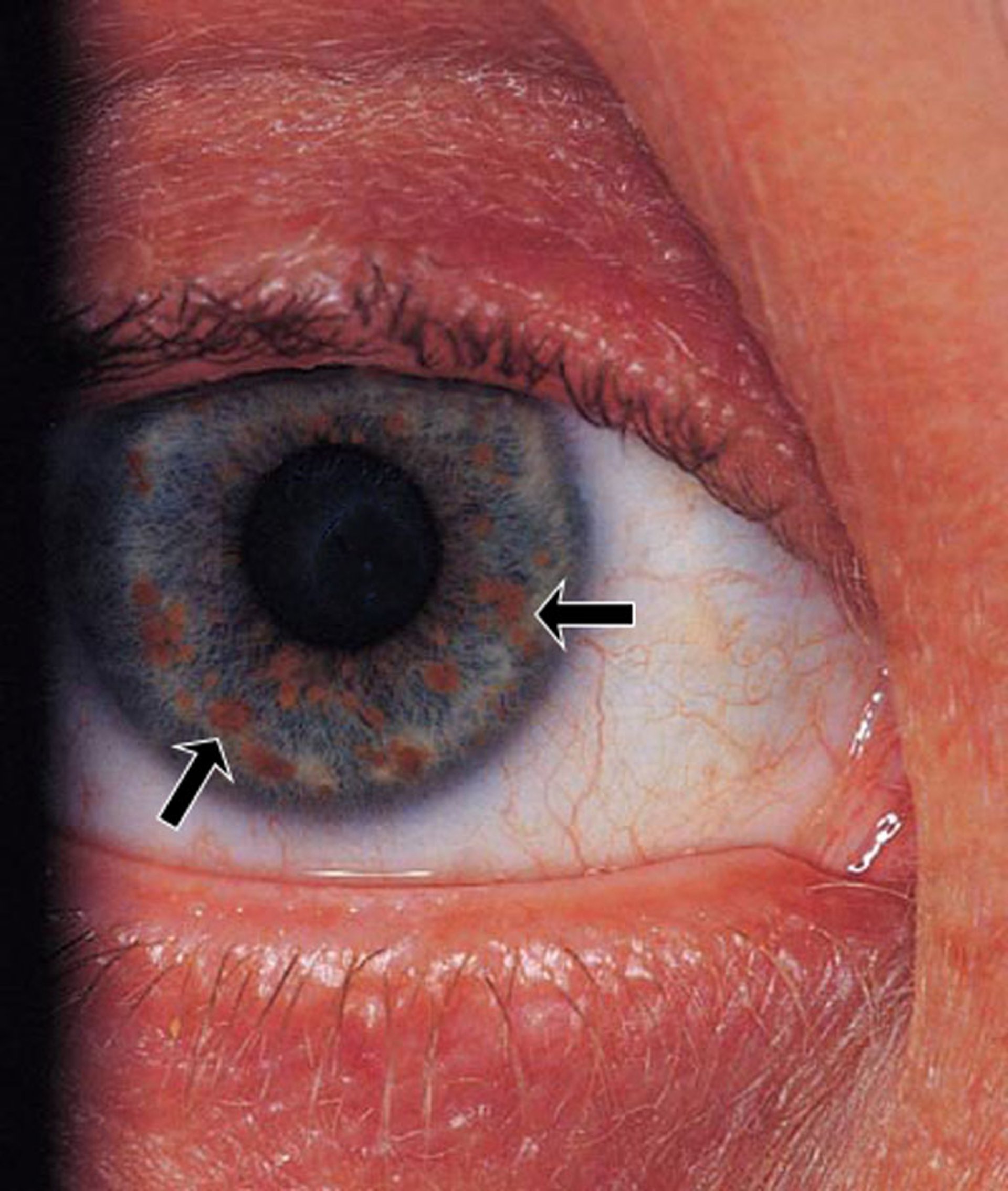 Lisch Nodules in Neurofibromatosis