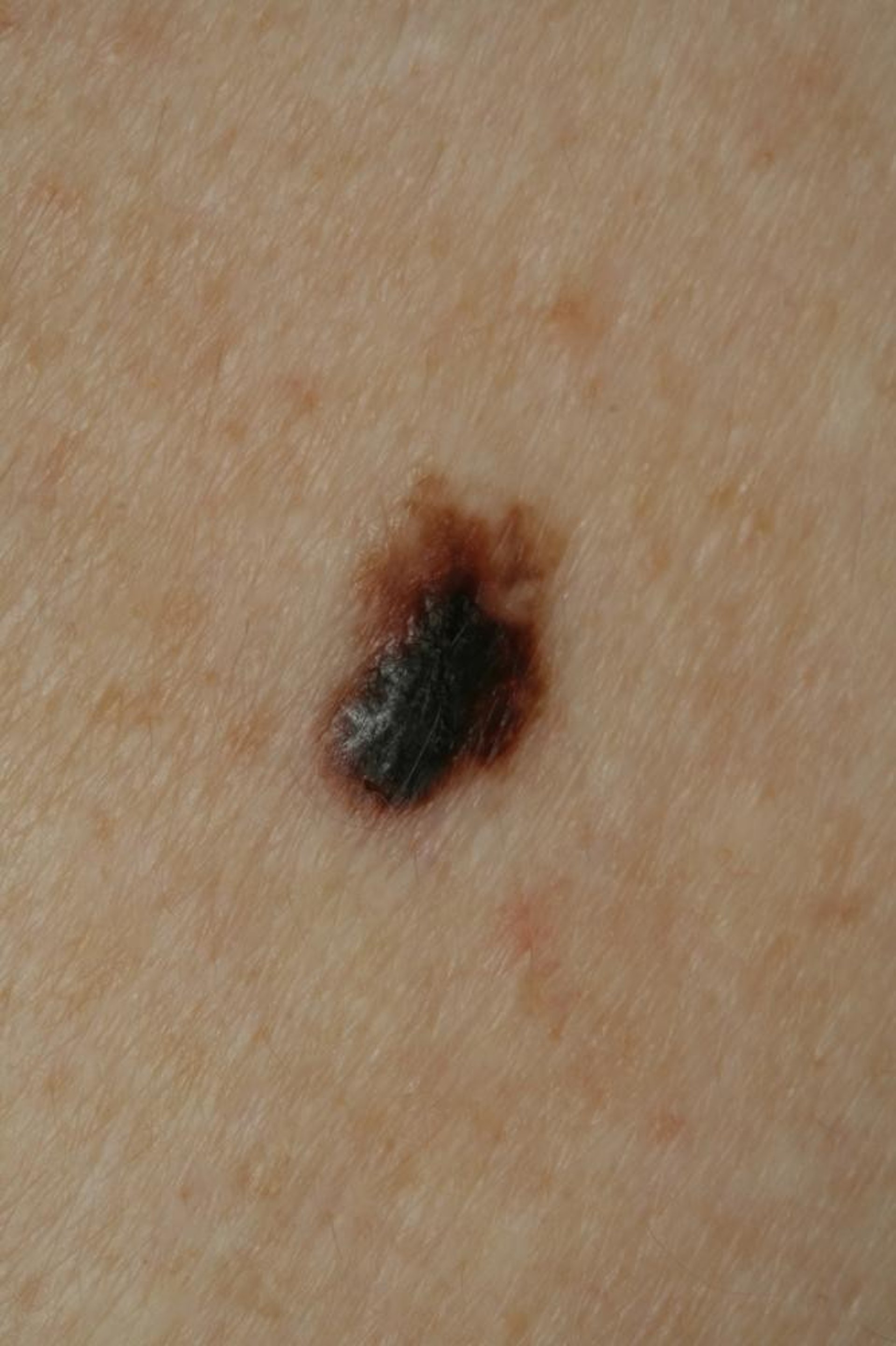 Melanoma nodular: