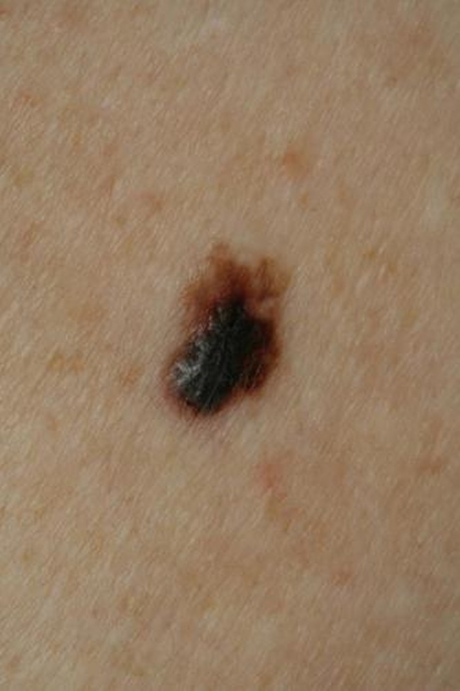 Melanoma