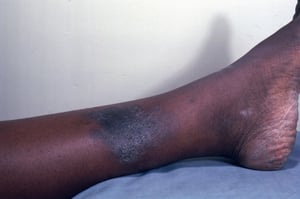 Nummular Dermatitis (4)