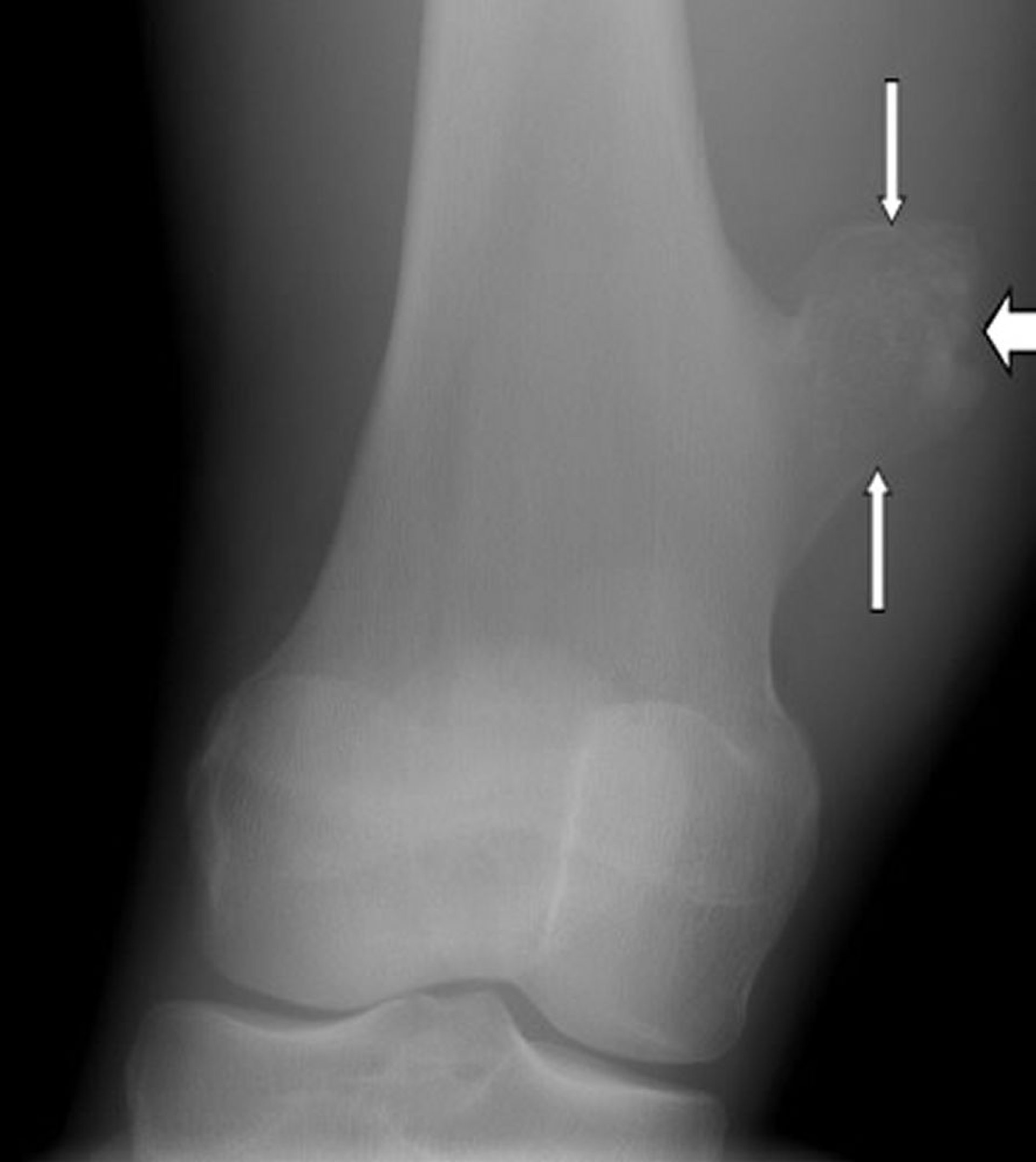 膝の骨軟骨腫