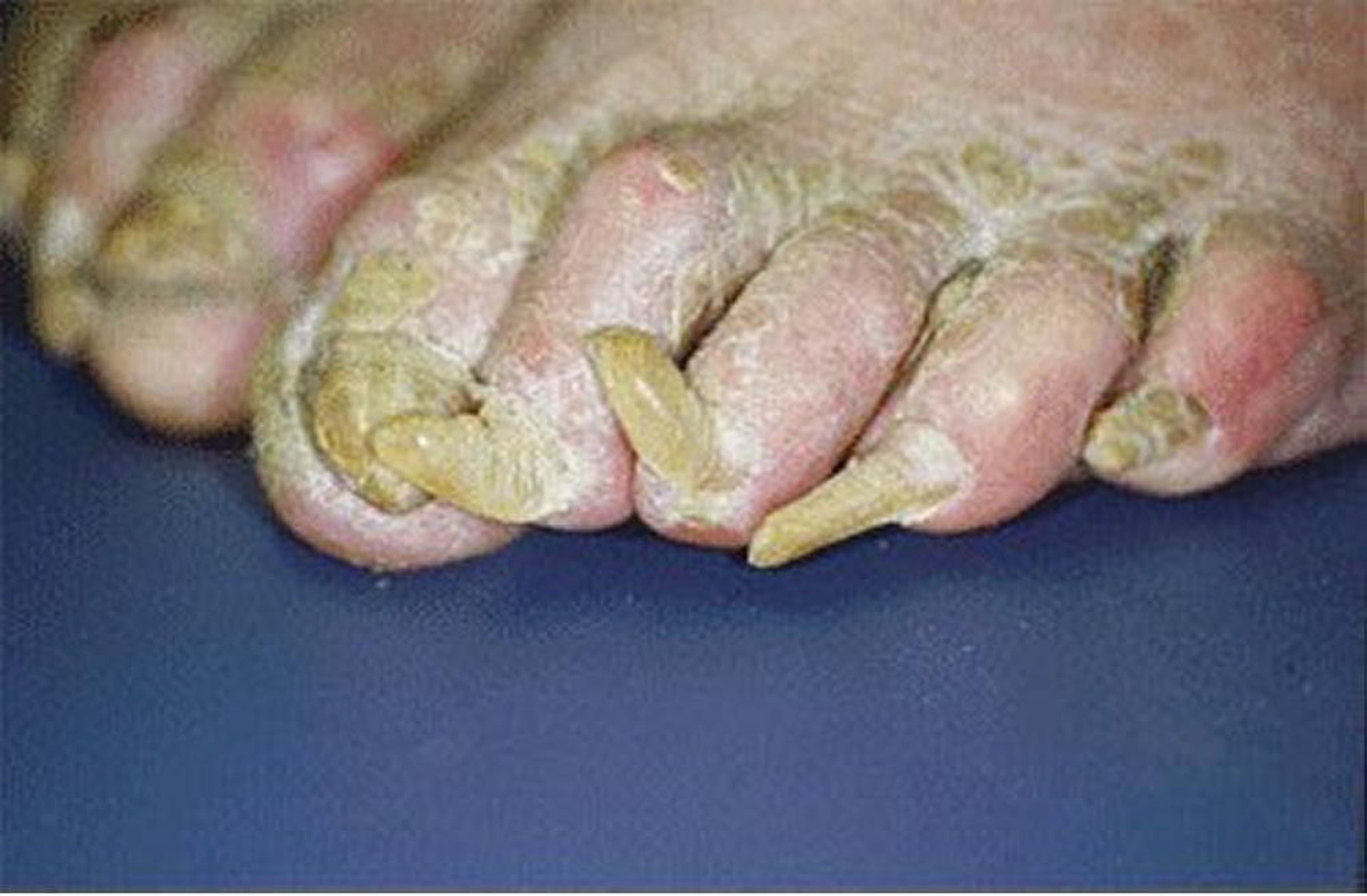 Onicogrifosis