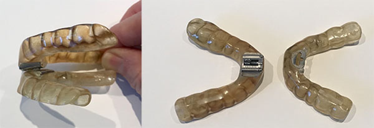 الجهاز الفموي لانقطاع التنفُّس في أثناء النوم