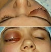 Orbitale Zellulitis