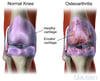 Osteoarthritis of the Knee
