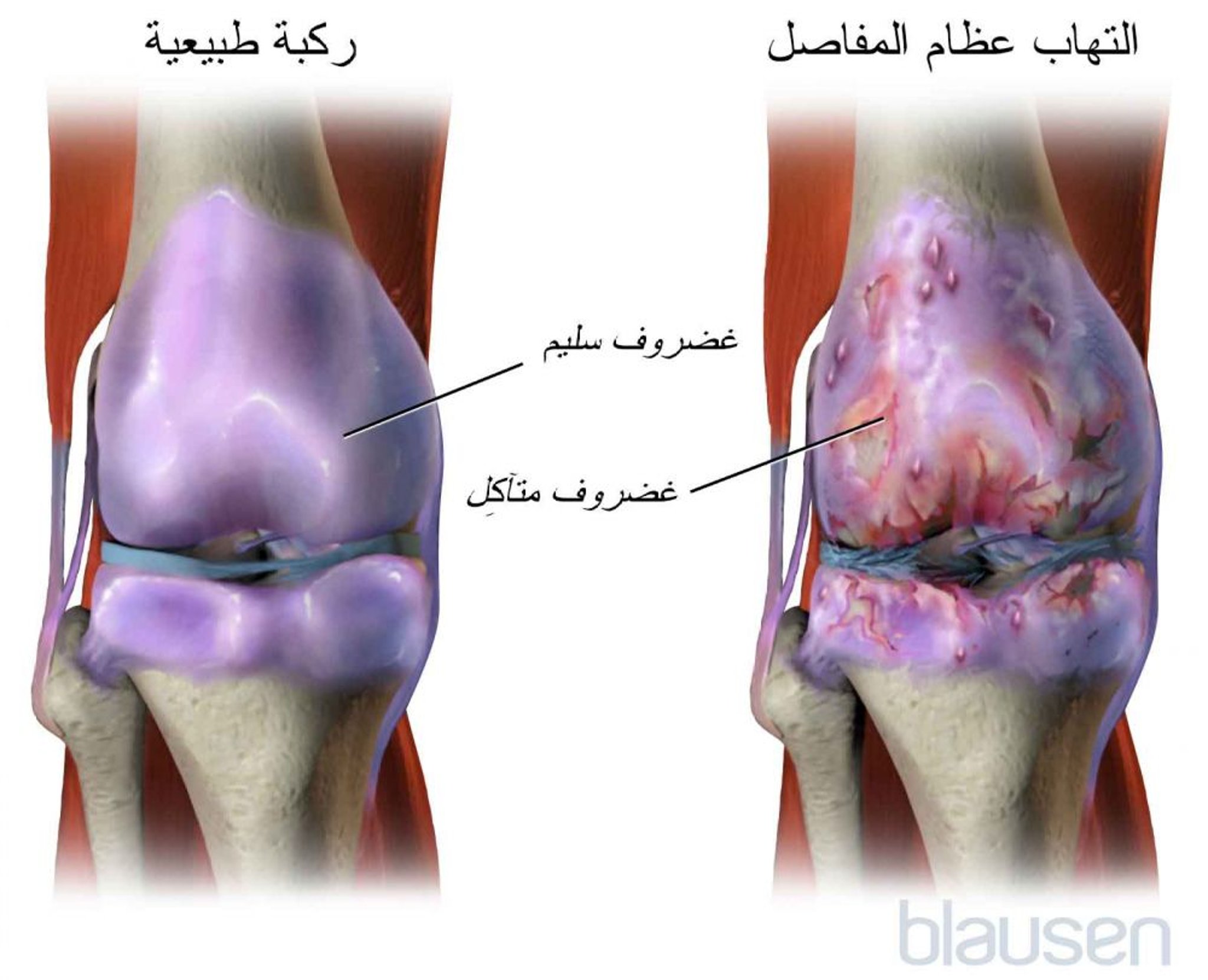 الفصال العظمي في الركبة