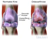 Arthrose des Kniegelenks