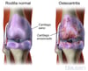 Artrosis de rodilla