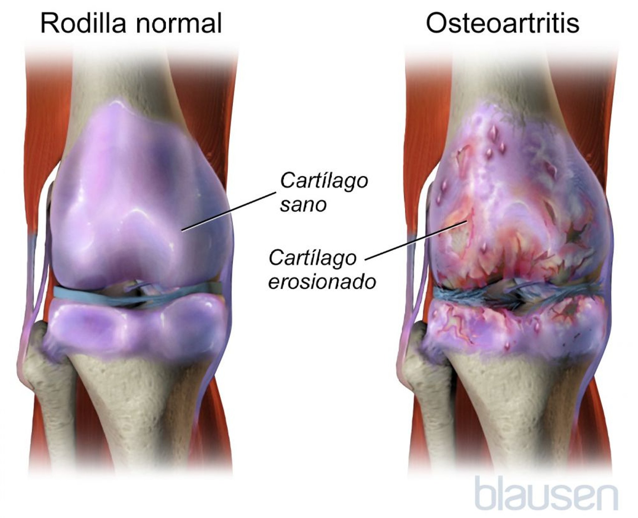 Artrosis de rodilla