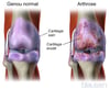 Arthrose du genou