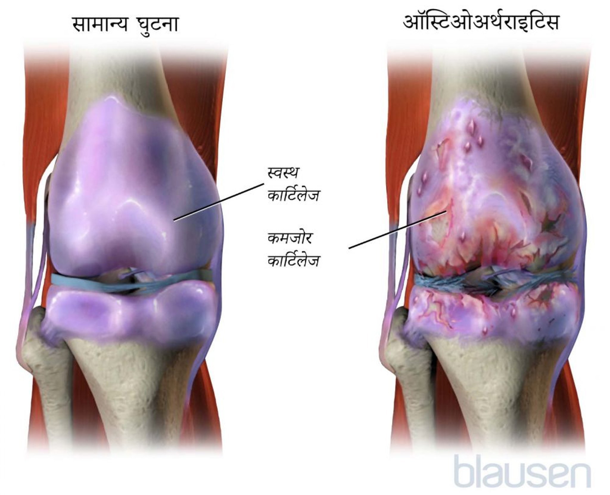घुटने का ऑस्टिओअर्थराइटिस