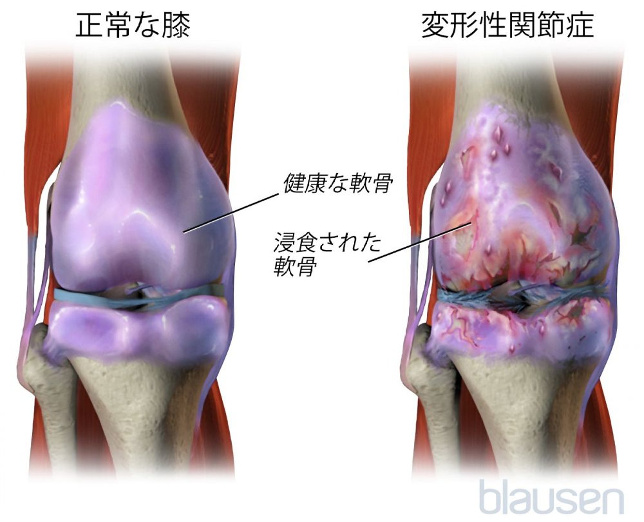 変形性膝関節症