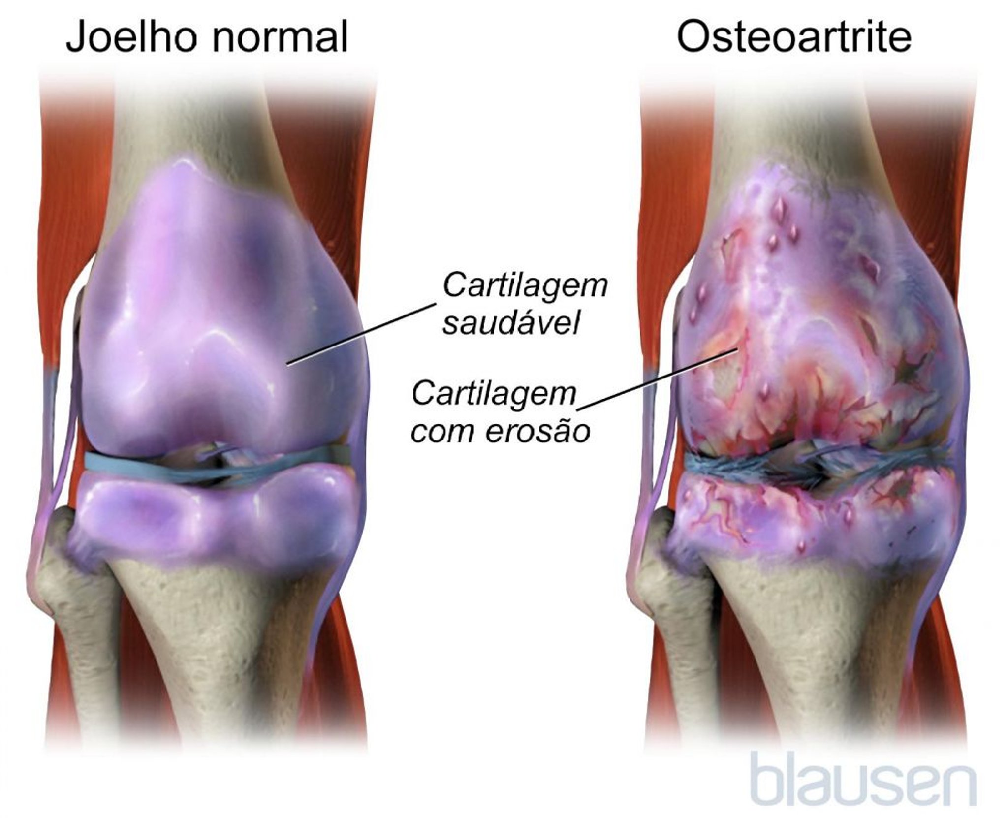 Osteoartrite do joelho