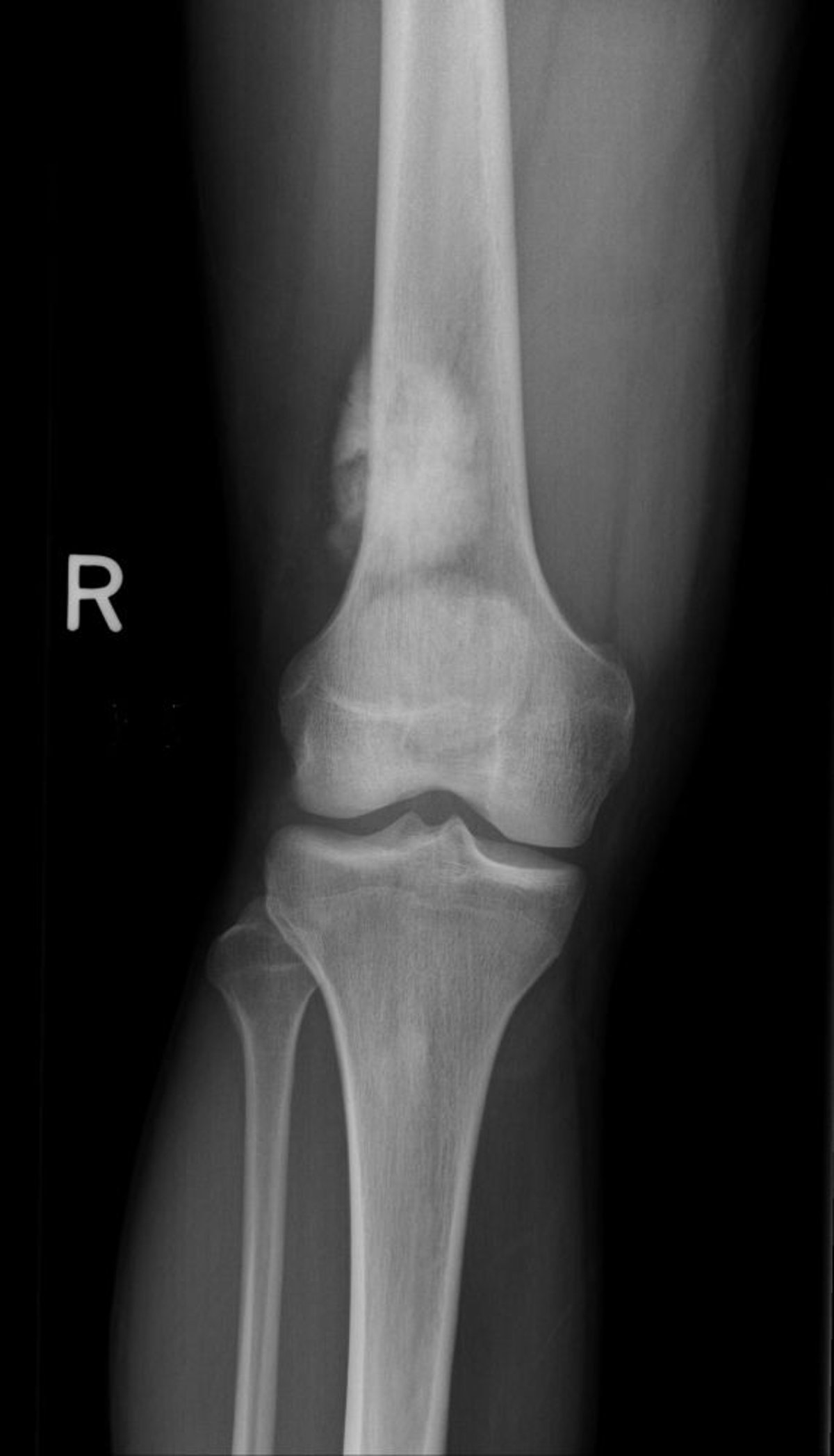 Osteosarcoma