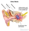 Otitis Media