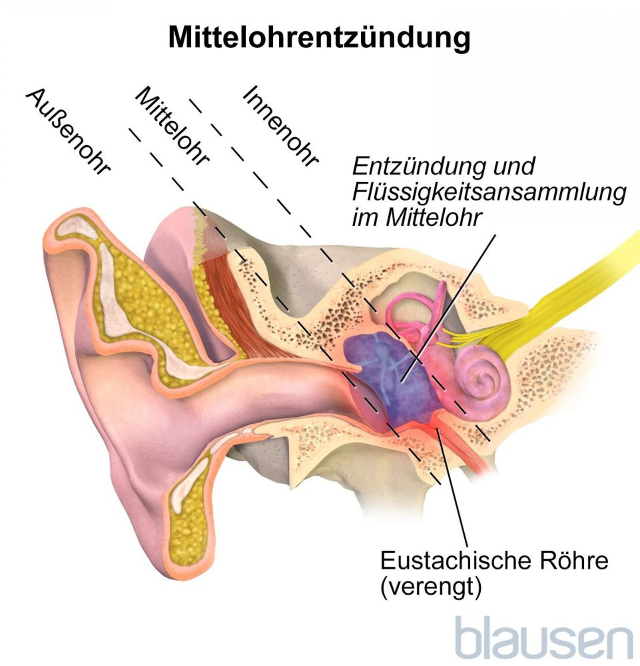 Mittelohrentzündung