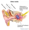 Otitis media