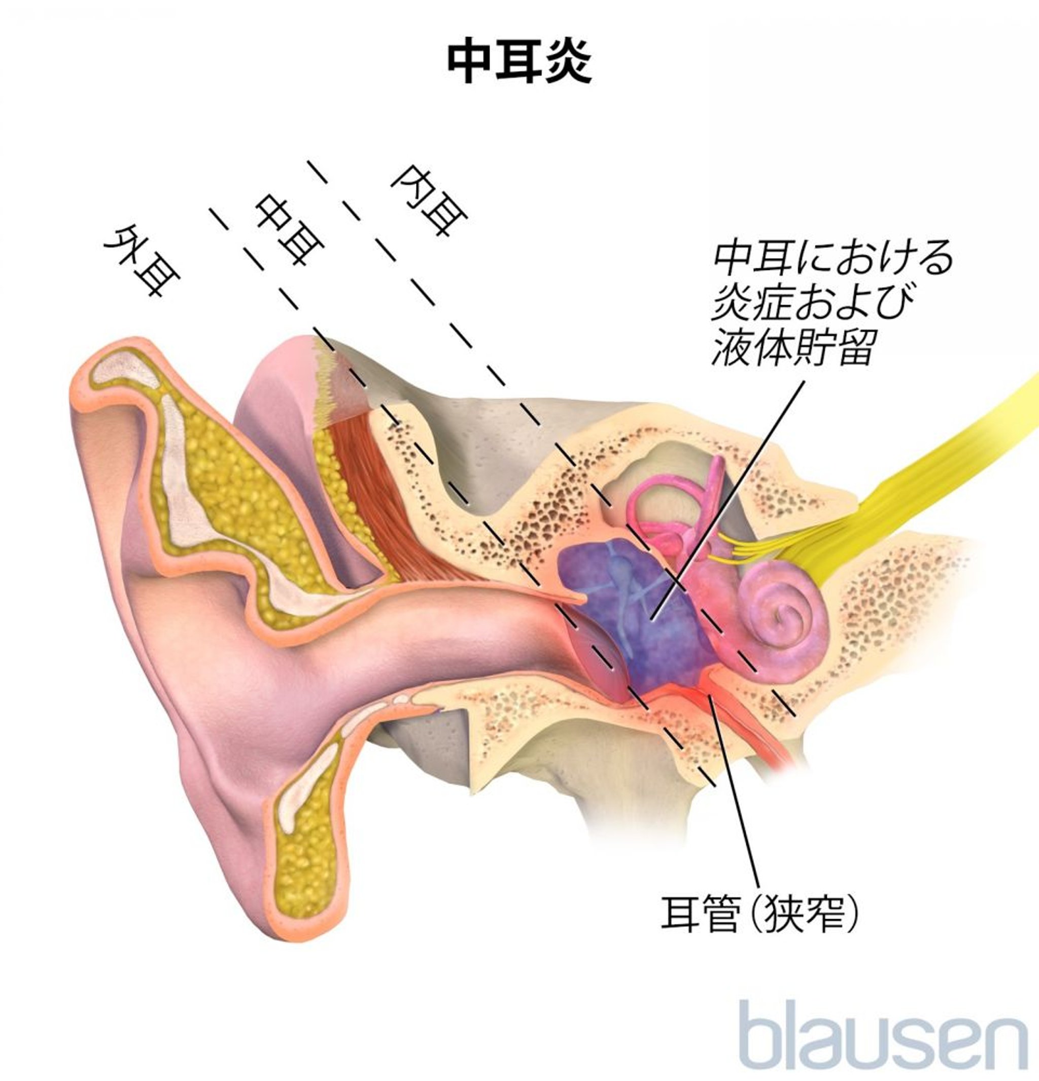 <ruby >中耳炎<rt >ちゅうじえん</rt></ruby>
