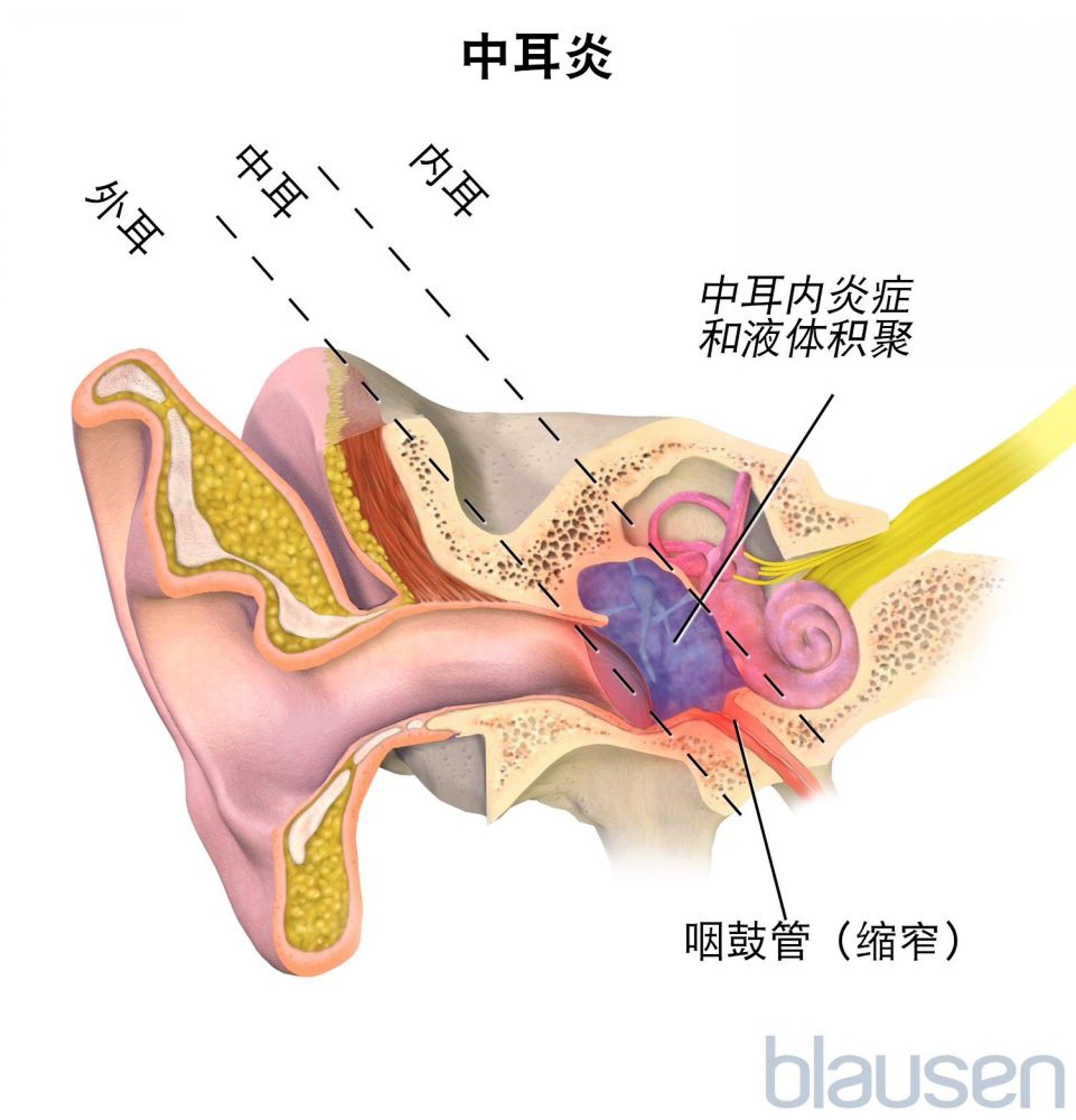 中耳炎