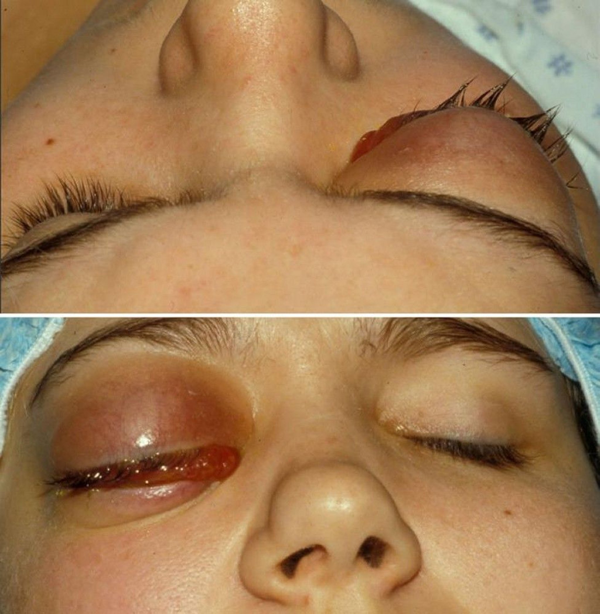 Orbital cellulitis