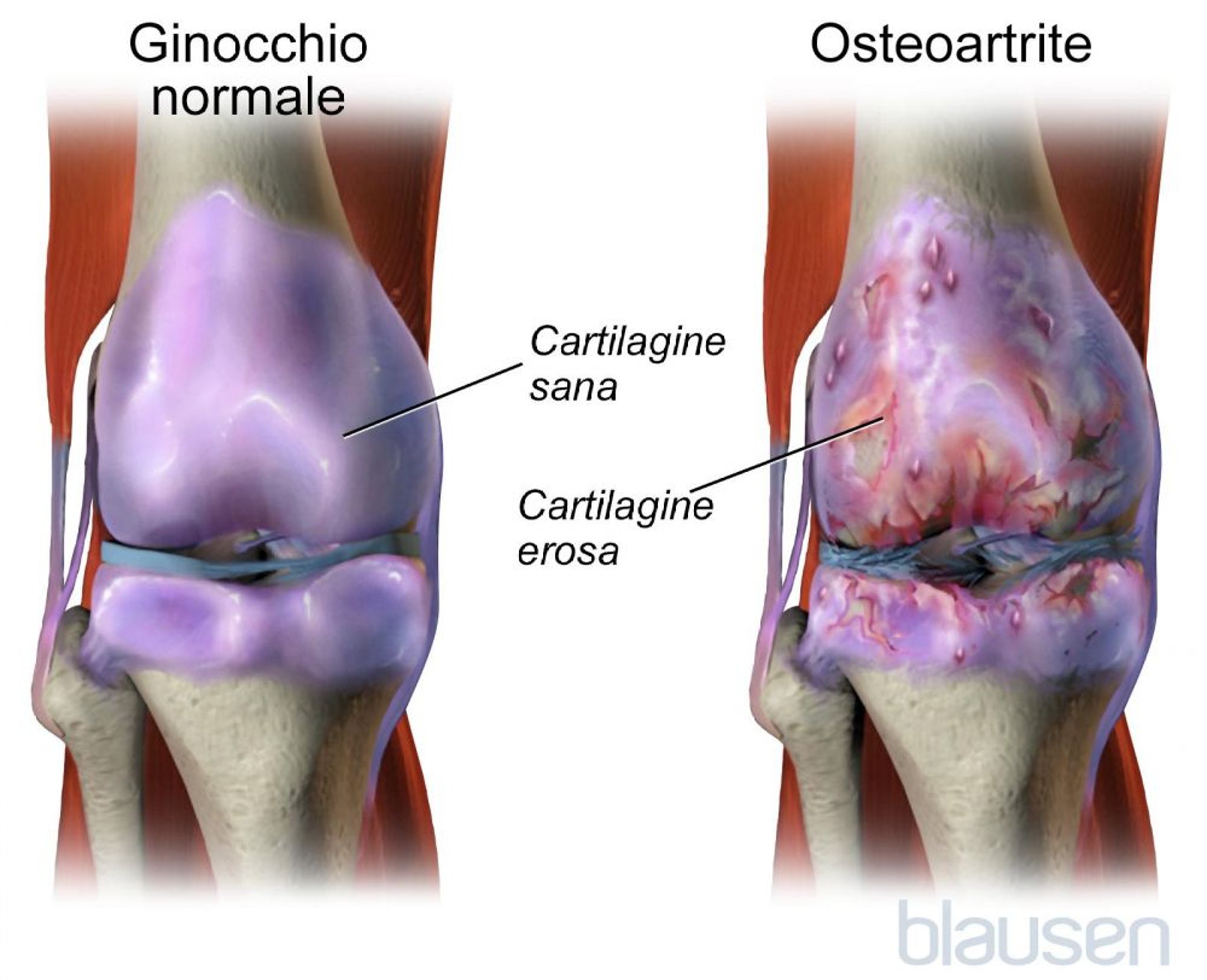 Osteoartrite del ginocchio