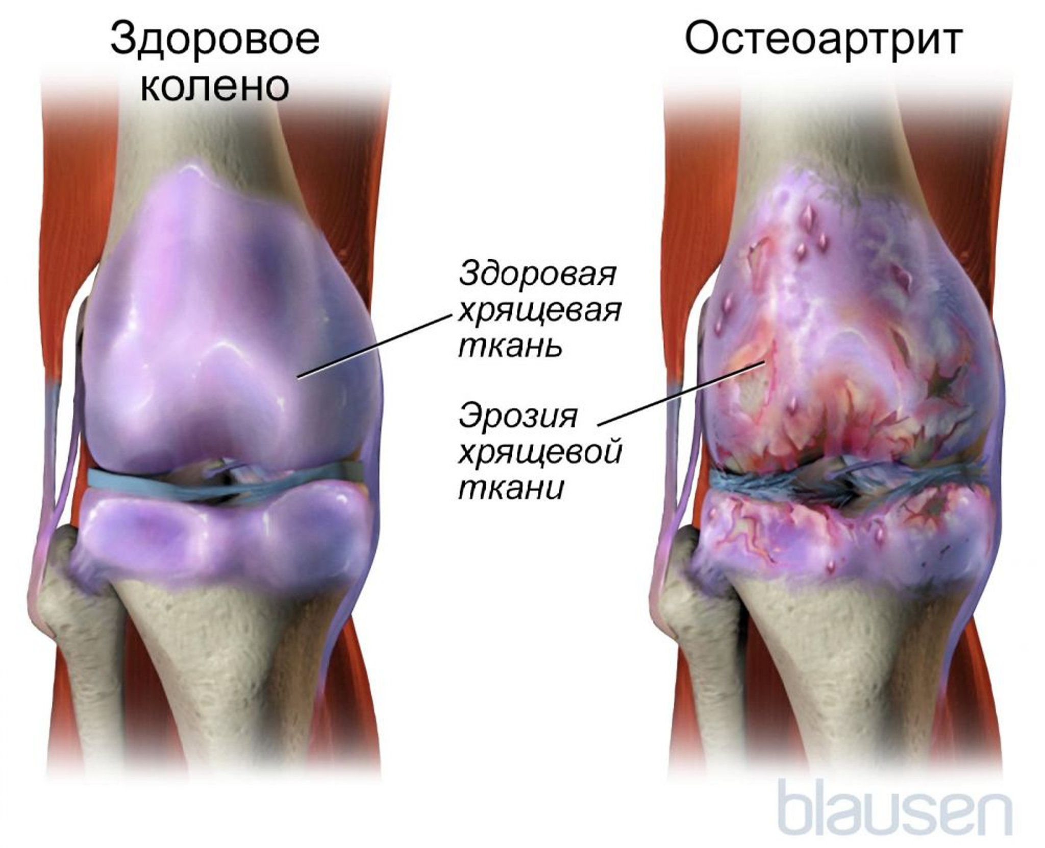 Остеоартрит коленного сустава