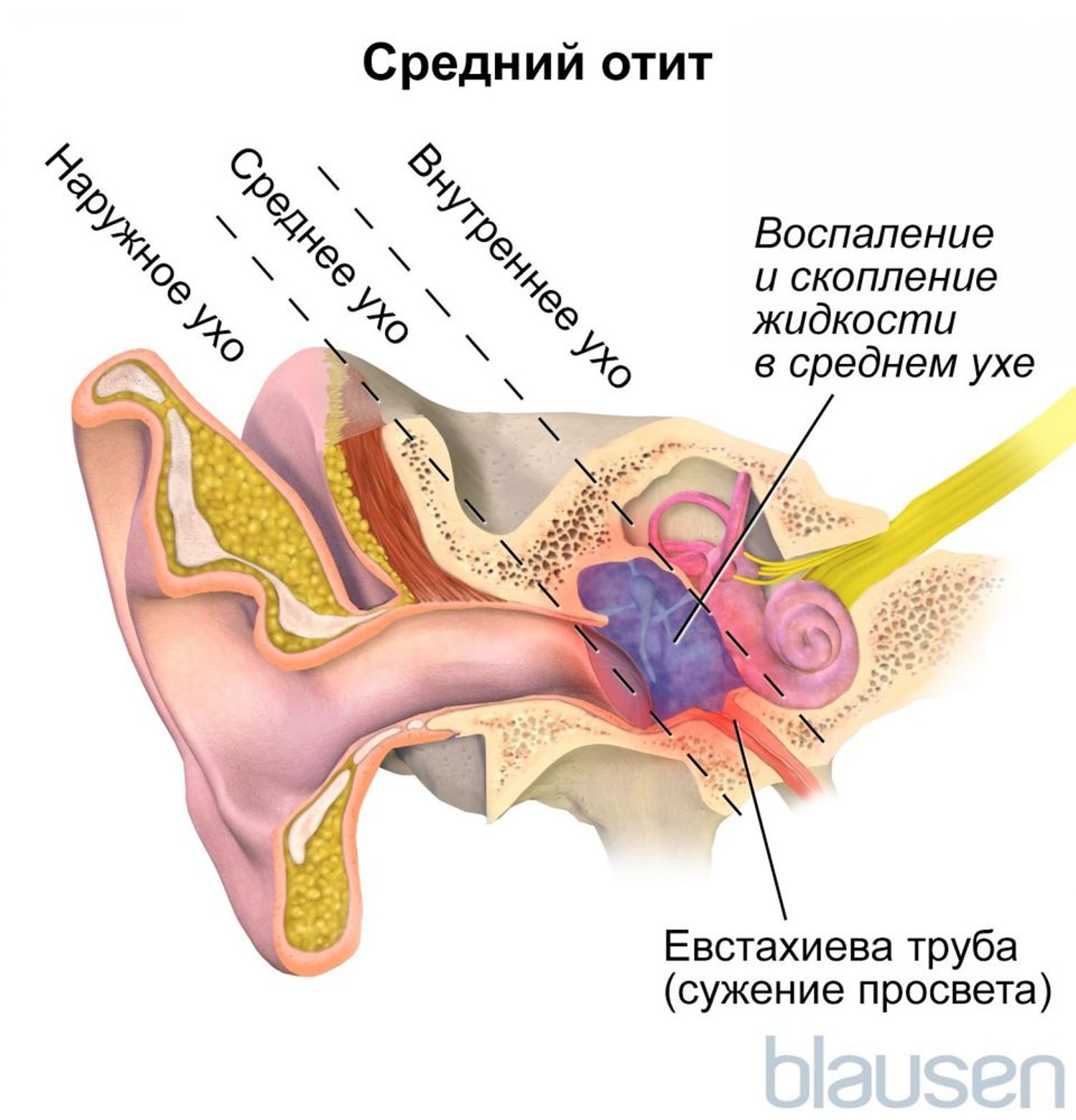 Средний отит