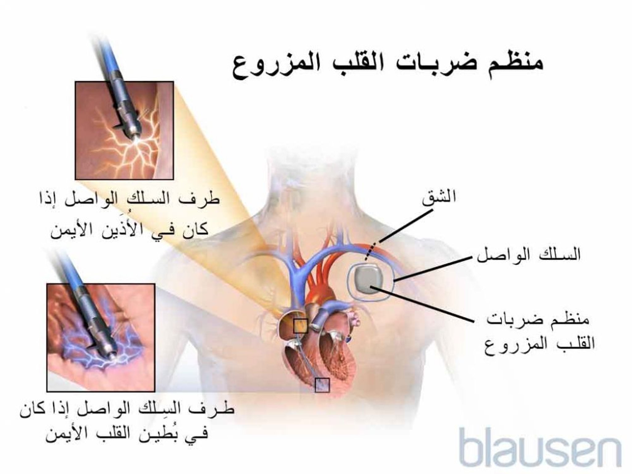 الناظمة القلبية القابلة للغرس