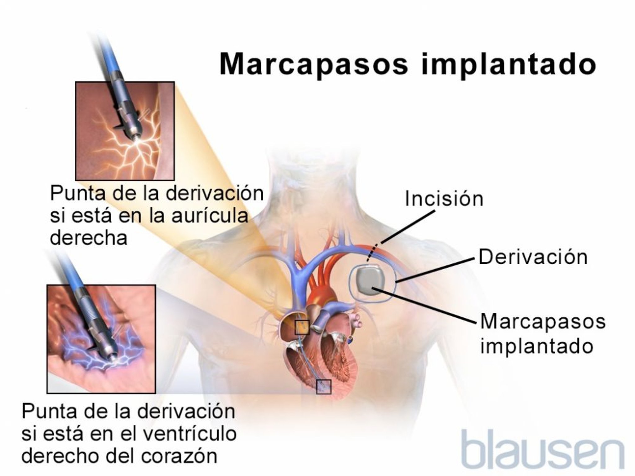 Marcapasos implantado