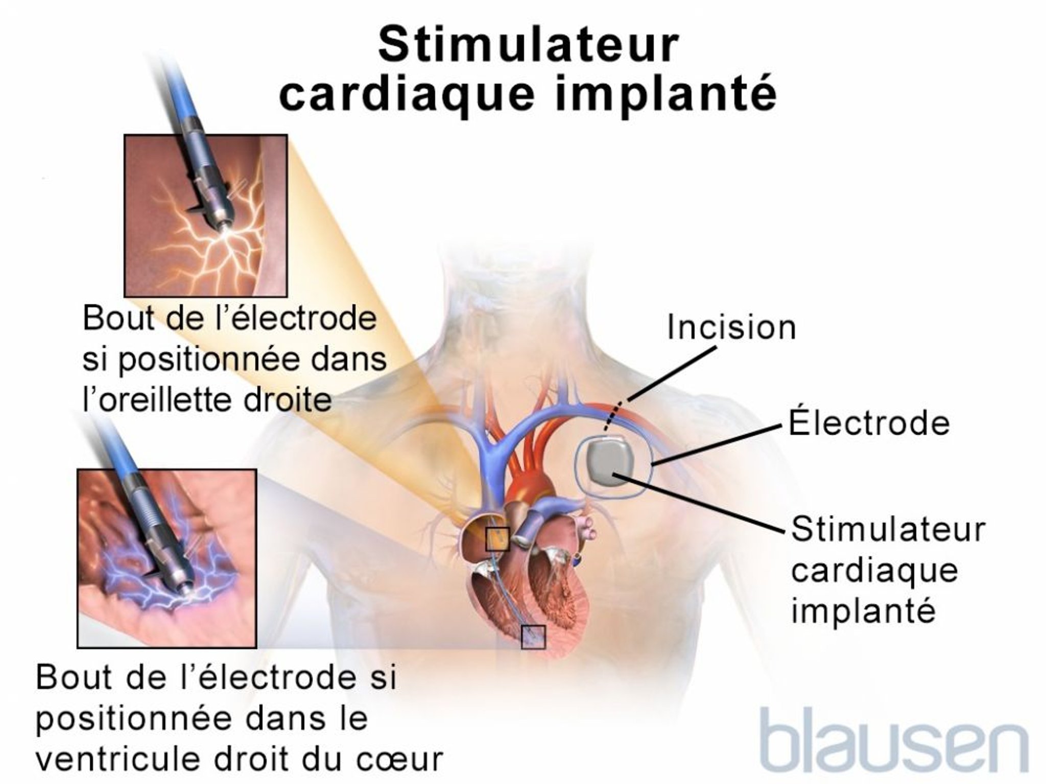 Stimulateur cardiaque implanté