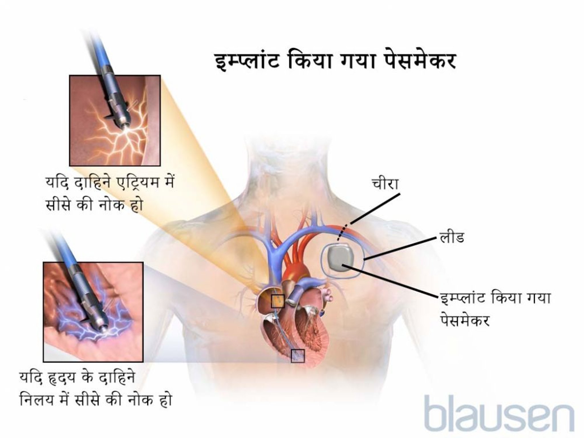 इम्प्लांट किया गया पेसमेकर