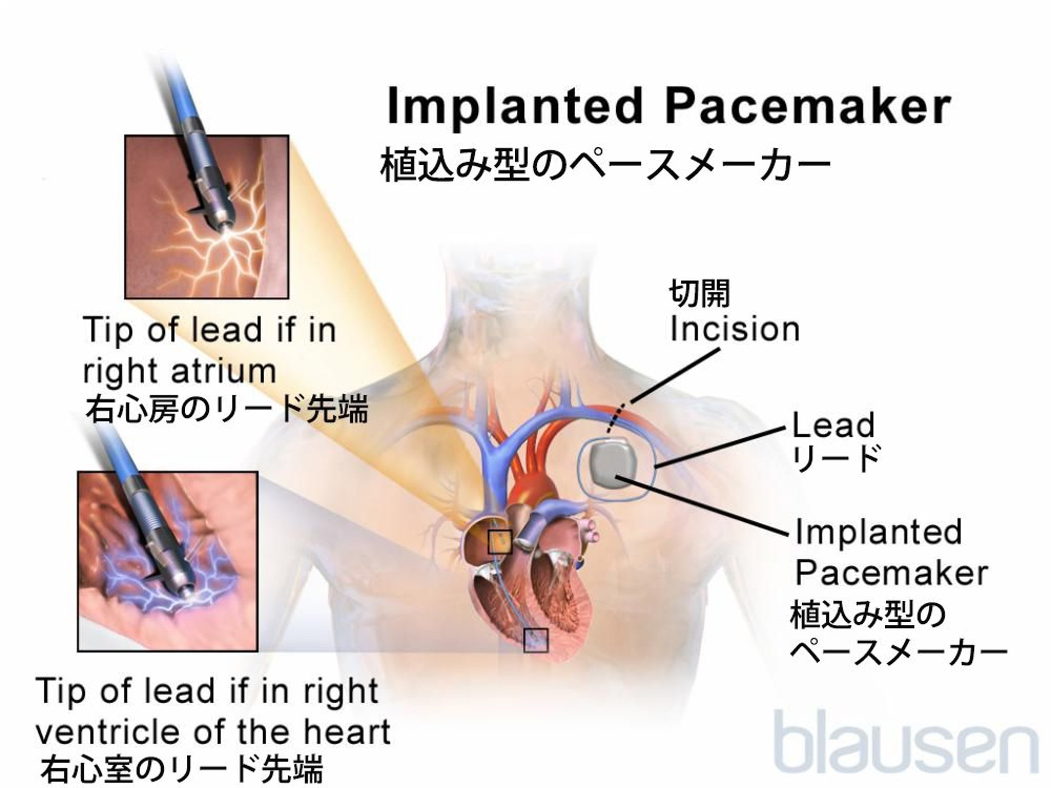 <ruby >植<rt >う</rt></ruby>え<ruby >込<rt >こ</rt></ruby>み<ruby >型<rt >がた</rt></ruby>ペースメーカー