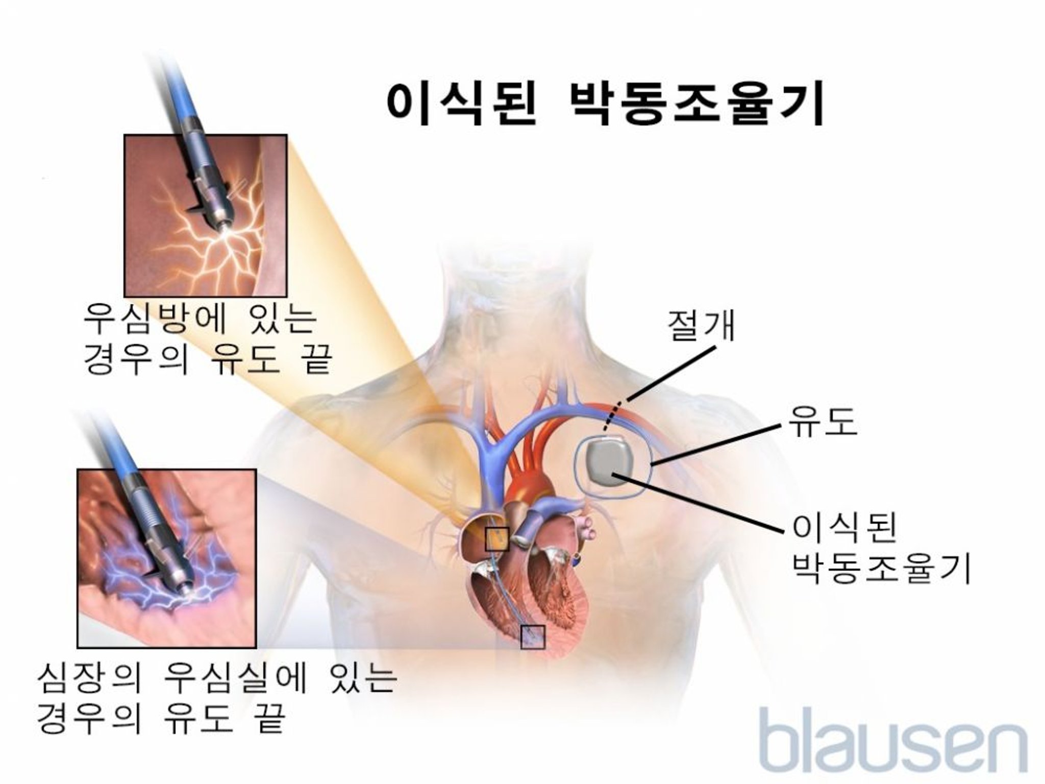 이식된 박동조율기