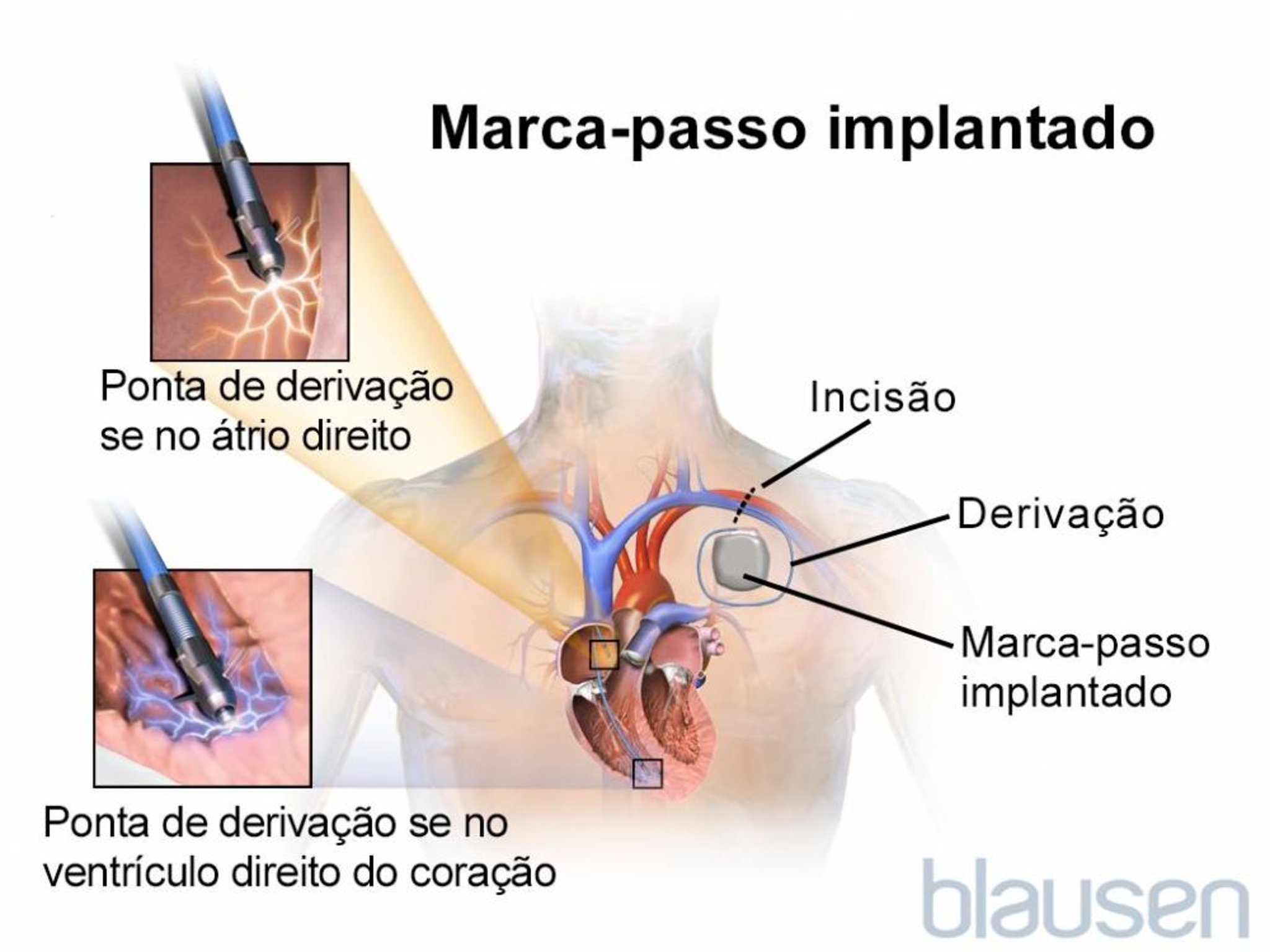 Marca-passo implantado