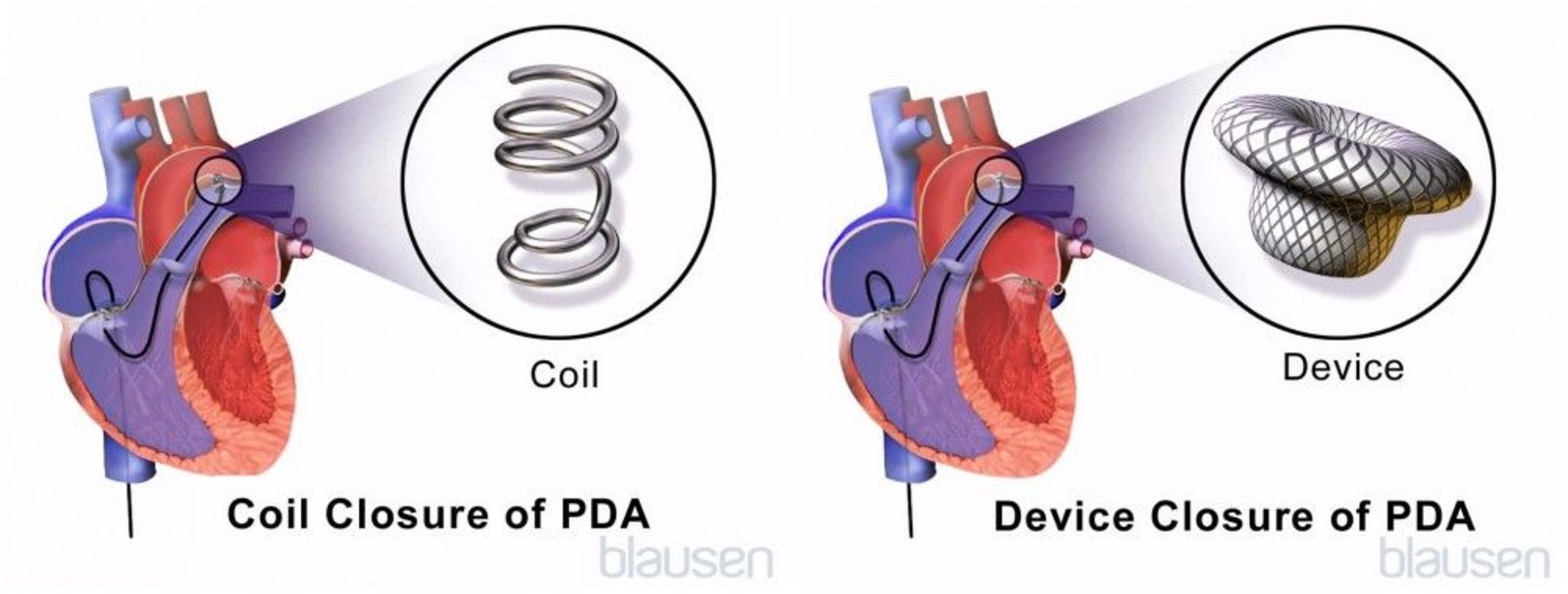 Patent Ductus Arteriosus (PDA) Repair