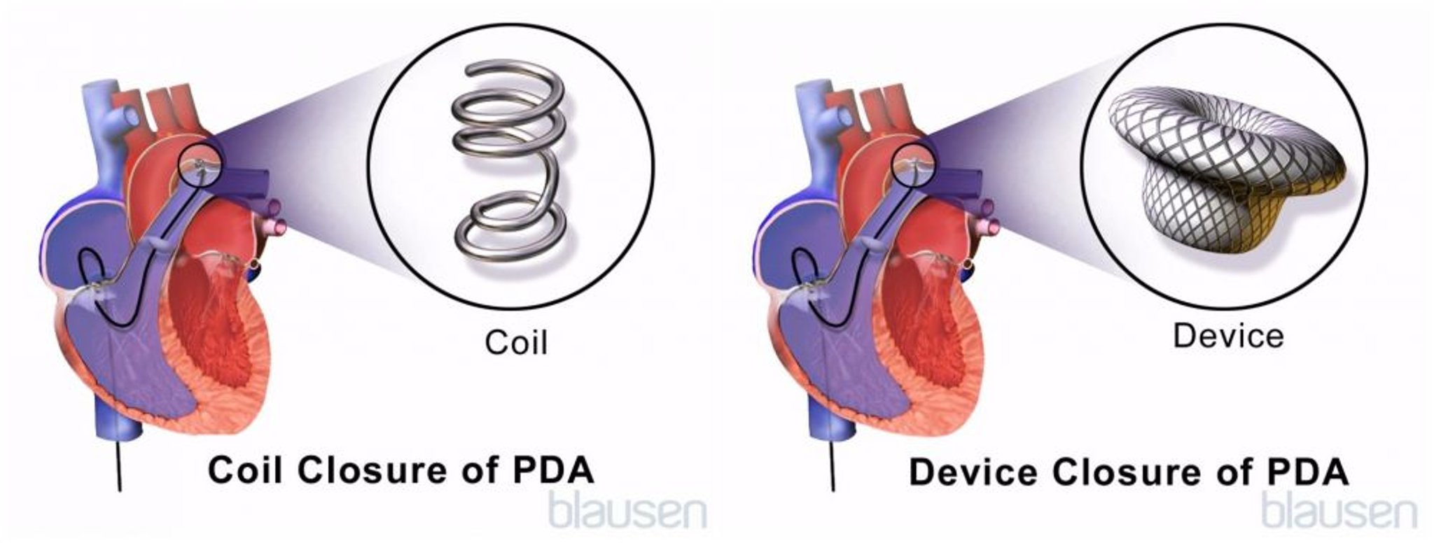 Reparatur eines persistierenden Ductus arteriosus (PDA)