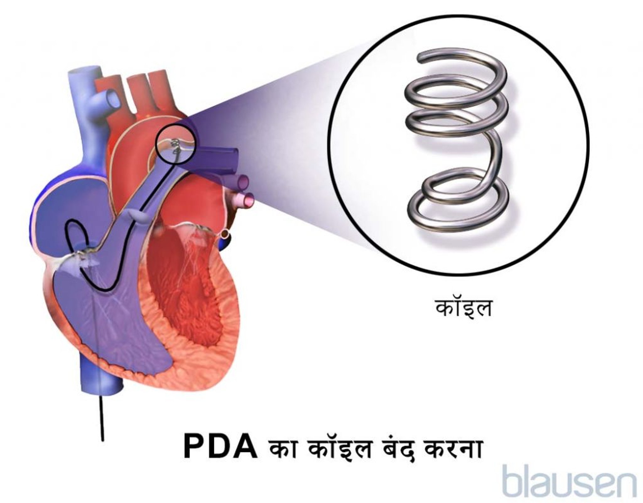 पेटेंट डक्टस आर्टिरियोसस (PDA) की मरम्मत