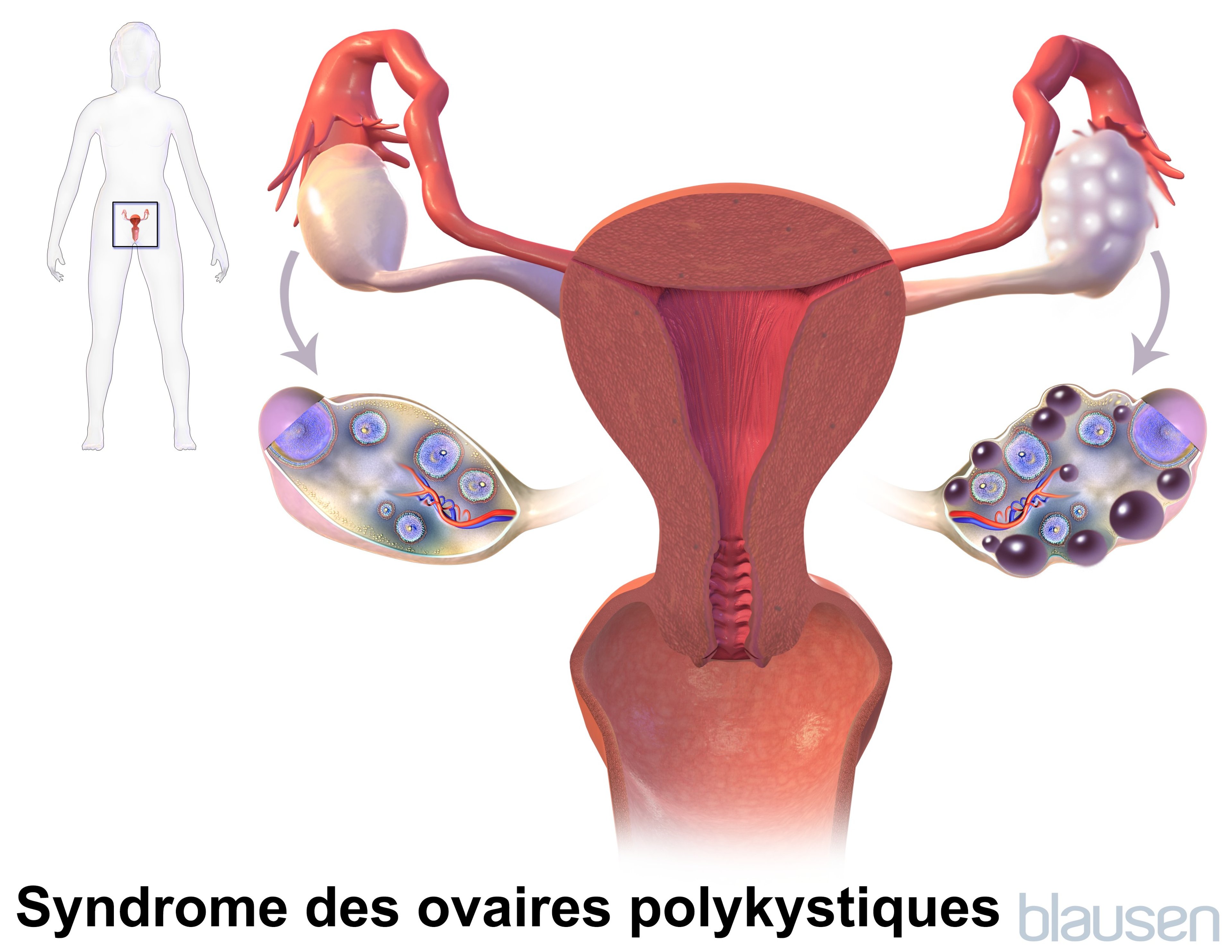 Syndrome des ovaires polykystiques (SOPK)