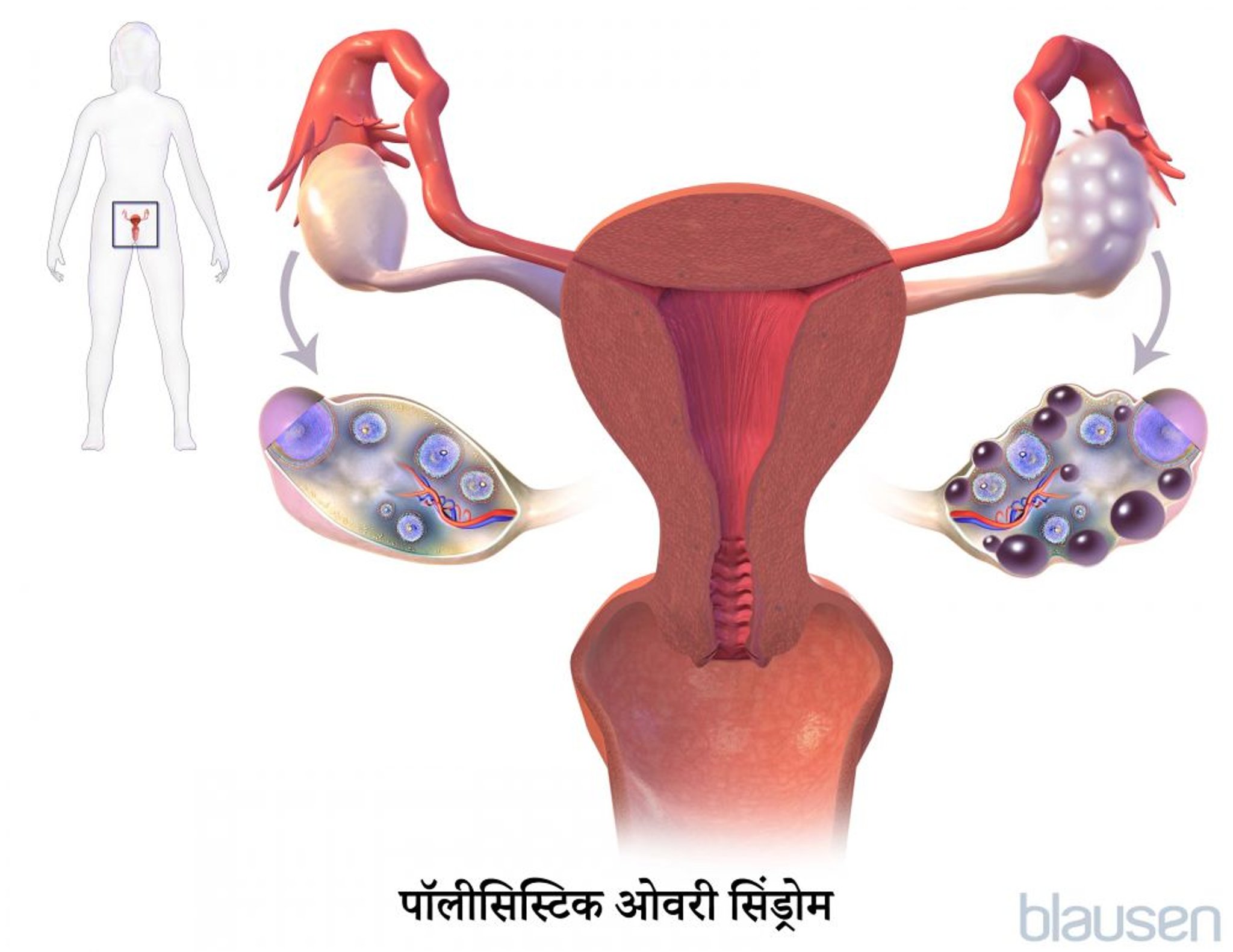 पॉलीसिस्टिक ओवरी सिंड्रोम (PCOS)
